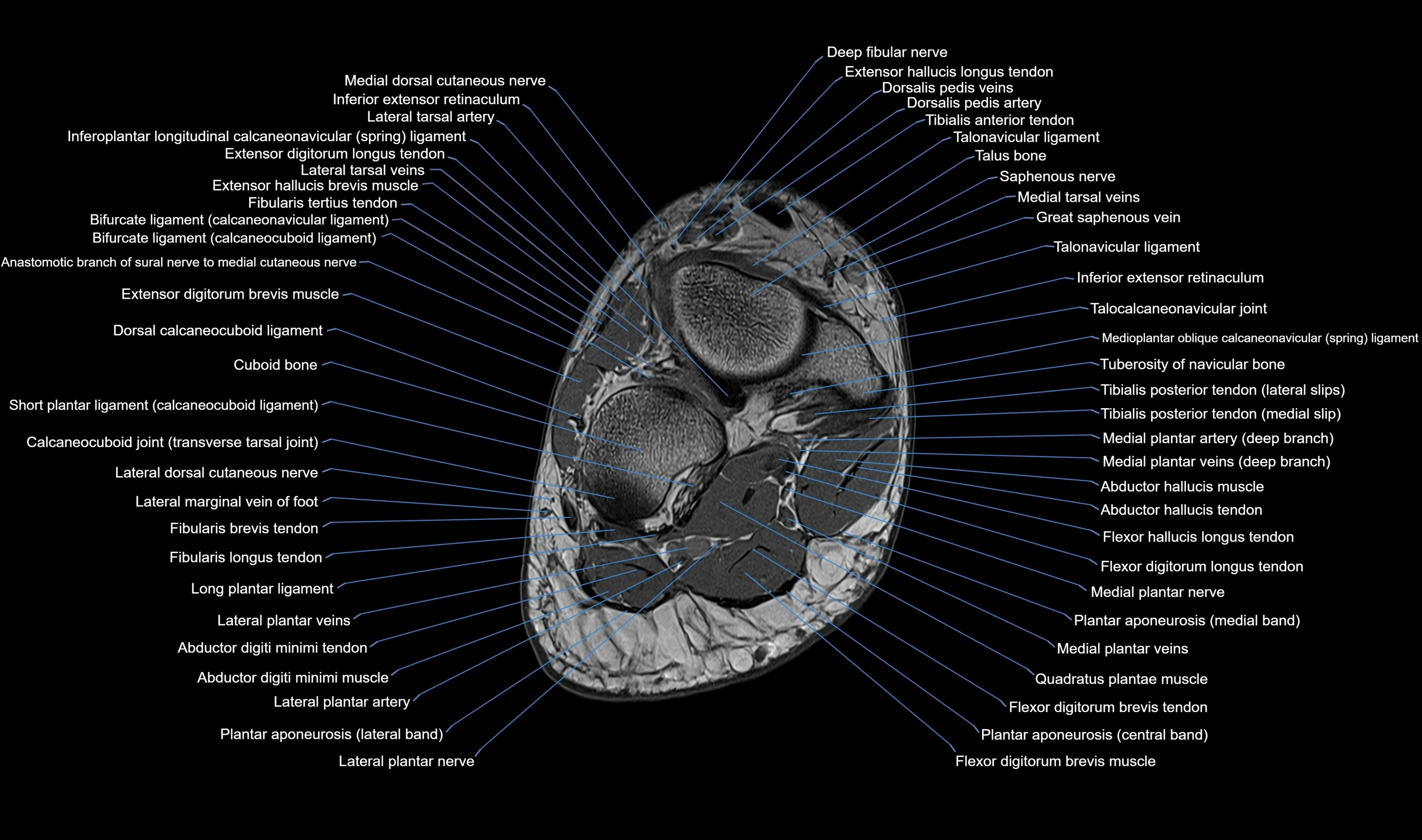 MRI mid foot axial cross sectional anatomy 3T  radiology  image-img-00001-00034.webp